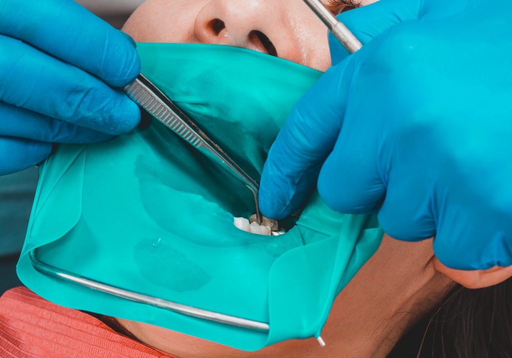 ラバーダムを使用した治療