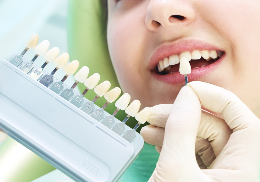 ホワイトニング